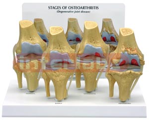 4-Stage Osteoarthritis Knee